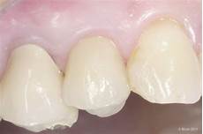 Ceramic Bonding Agent