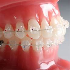 Ceramic Bonding