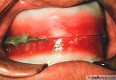 Dental Plaster