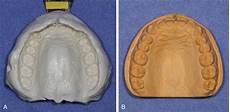 Dental Plaster