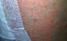 Elastic Wound Plaster