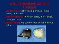 Metal Ceramic Bonding