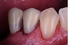 Metal Ceramic Bonding