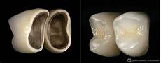 Metal Ceramic Bonding