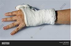 Plaster Hand