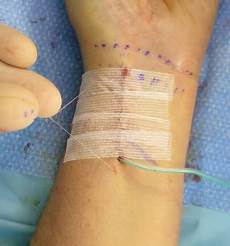Surgical Type Adhesive Plaster