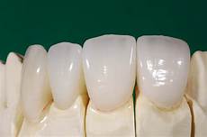 Zirconia Adhesive